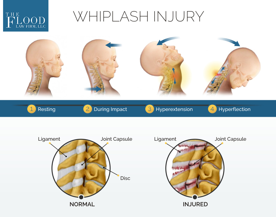 Neck Injuries from a Car Accident