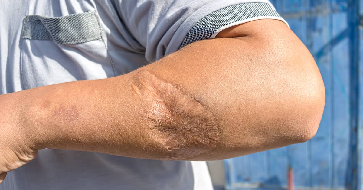 man showing the scar from a dog bite injury on his forearm